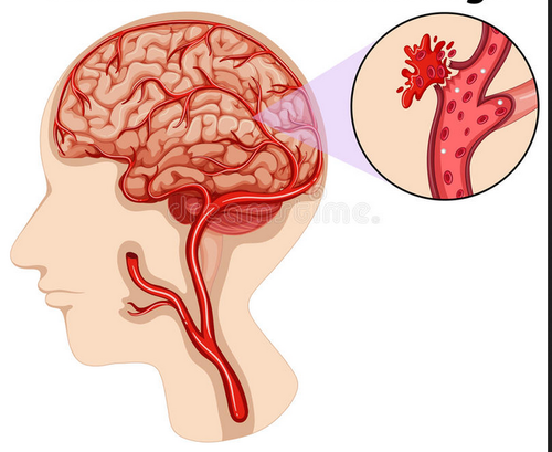 के हो मस्तिष्कघात, किन हुन्छ र के हुन् लक्षण ?